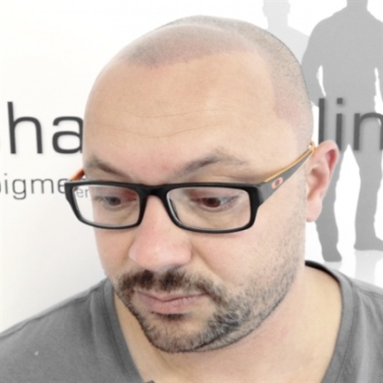The Shadow Clinic - Male Hair Loss Treatment & Solutions in Auckland NZ